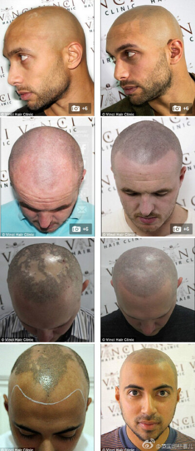 英国男人们最近开始流行头皮纹身在没头发的地方纹上发际线呃