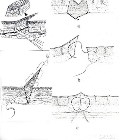 连续皮内缝合的经验与技巧